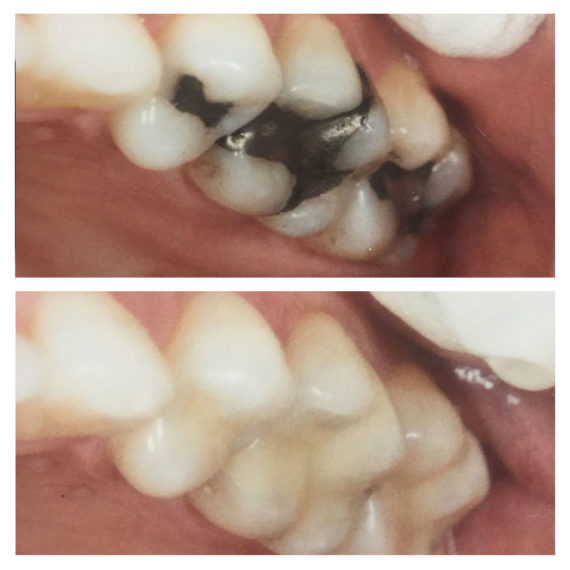 Dental Work Before and After