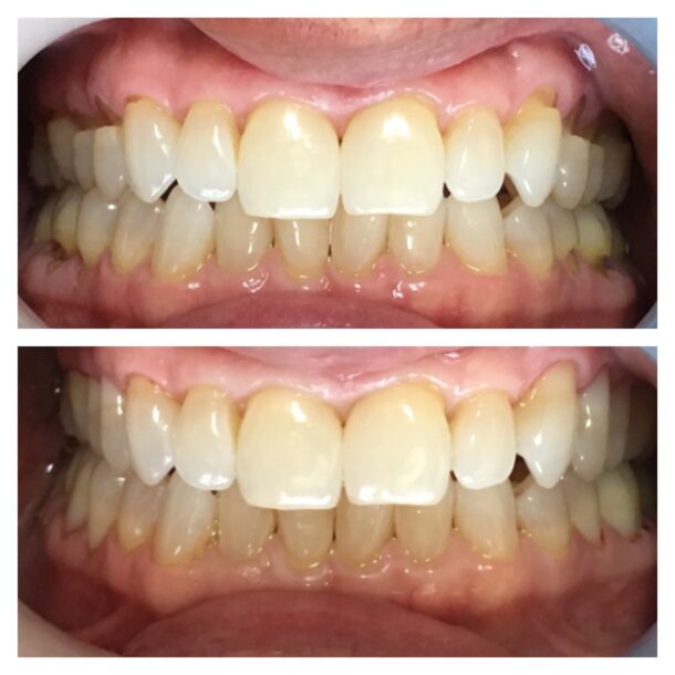 Dental Work Before and After